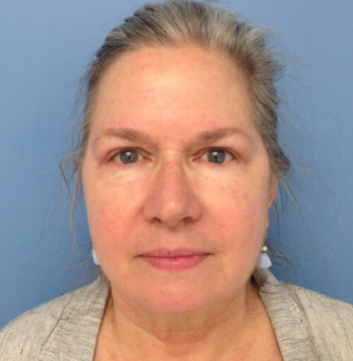 Eyelid Surgery
