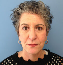 Eyelid Surgery