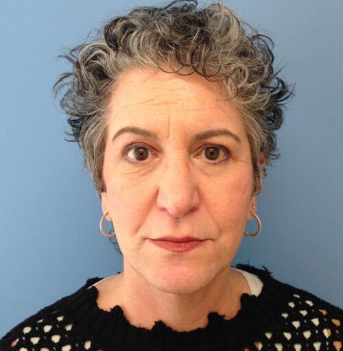 Eyelid Surgery