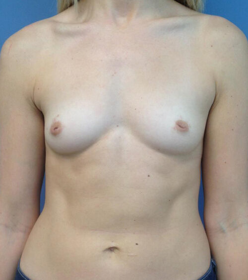 Breast Augmentation Before & After Photos