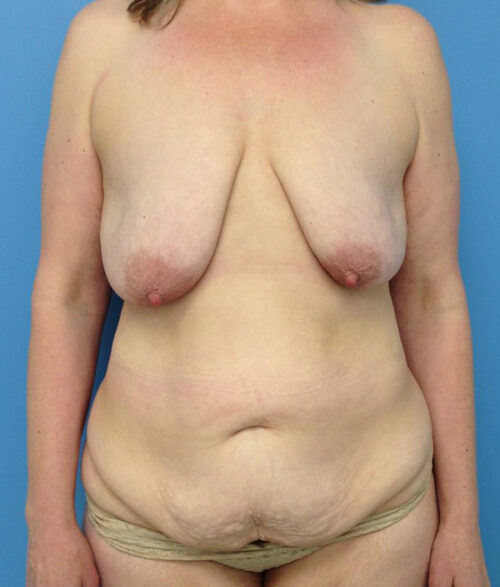 Breast Lift