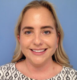 Face & Neck Lift