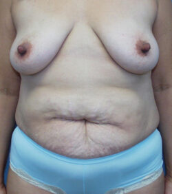 Tummy Tuck (Abdominoplasty) Before and After Photos