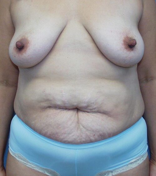 Tummy Tuck (Abdominoplasty) Before and After Photos