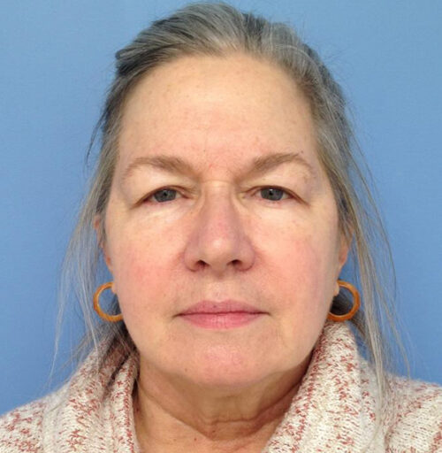 Eyelid Surgery
