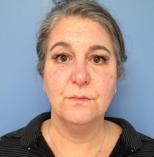Eyelid Surgery