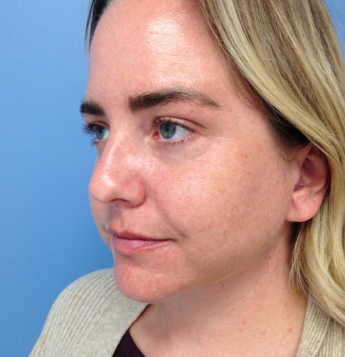 Face & Neck Lift
