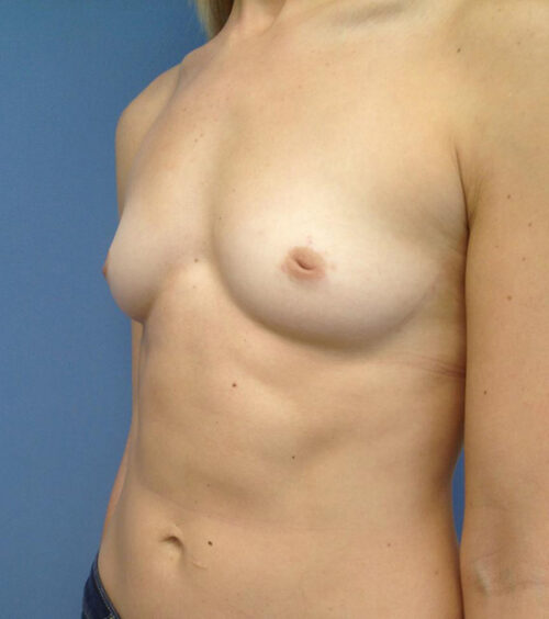 Breast Augmentation Before & After Photos