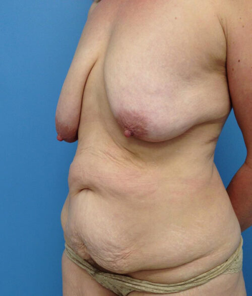 Breast Lift
