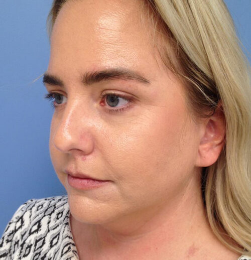 Face & Neck Lift