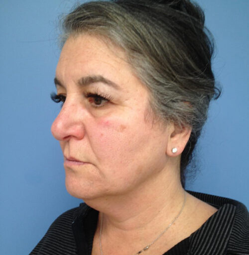 Eyelid Surgery