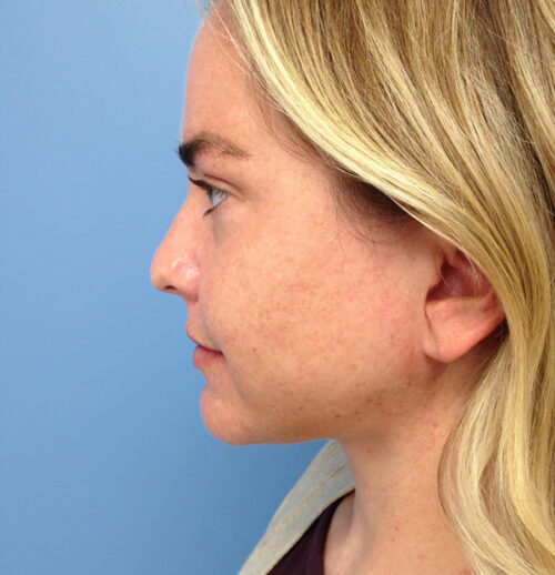 Face & Neck Lift