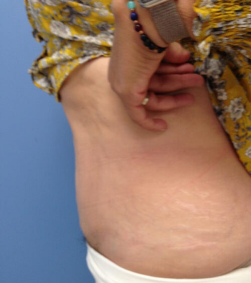 Tummy Tuck (Abdominoplasty) Before and After Photos
