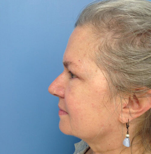 Eyelid Surgery