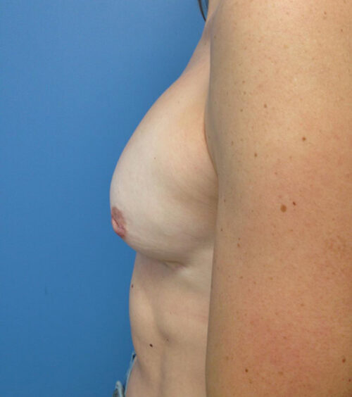 Breast Augmentation Before & After Photos
