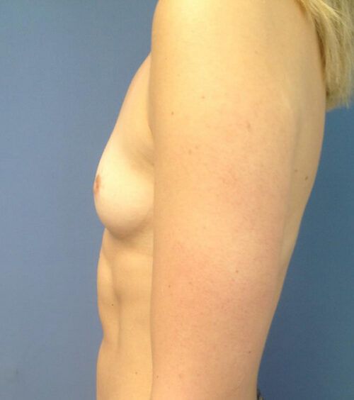 Breast Augmentation Before & After Photos
