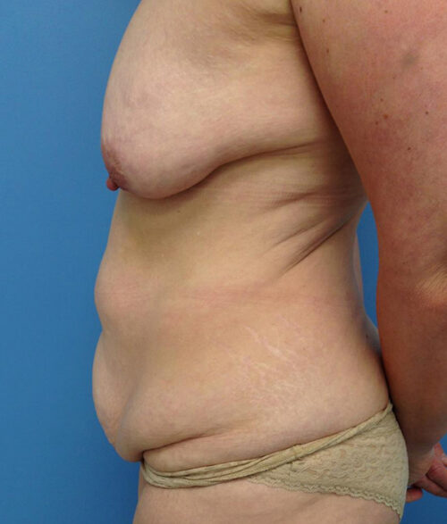 Breast Lift