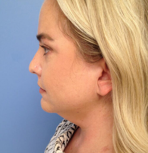 Face & Neck Lift