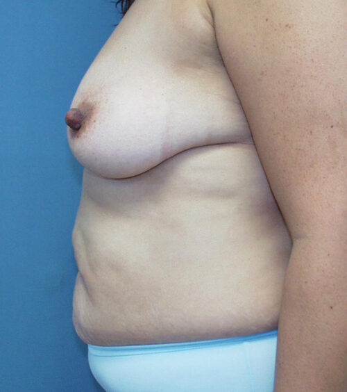 Tummy Tuck (Abdominoplasty) Before and After Photos