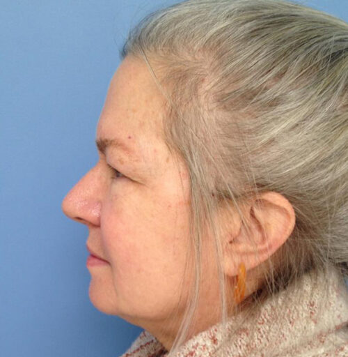 Eyelid Surgery