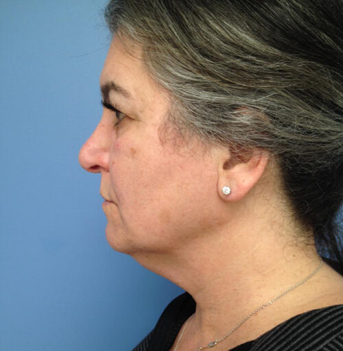 Eyelid Surgery