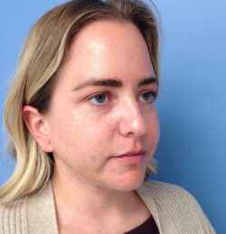 Face & Neck Lift