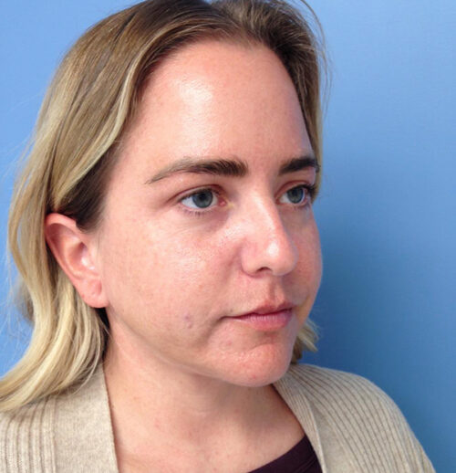Face & Neck Lift