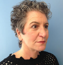 Eyelid Surgery