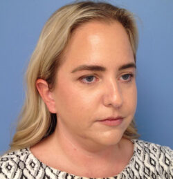 Face & Neck Lift