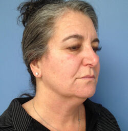 Eyelid Surgery