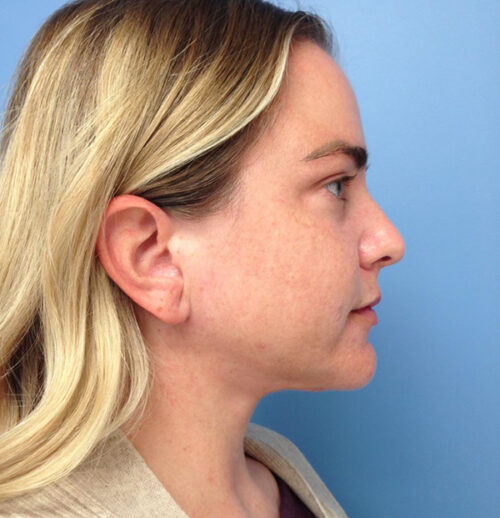 Face & Neck Lift