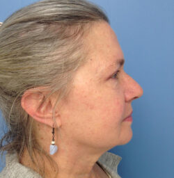 Eyelid Surgery