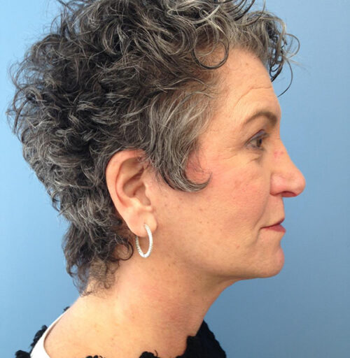 Eyelid Surgery