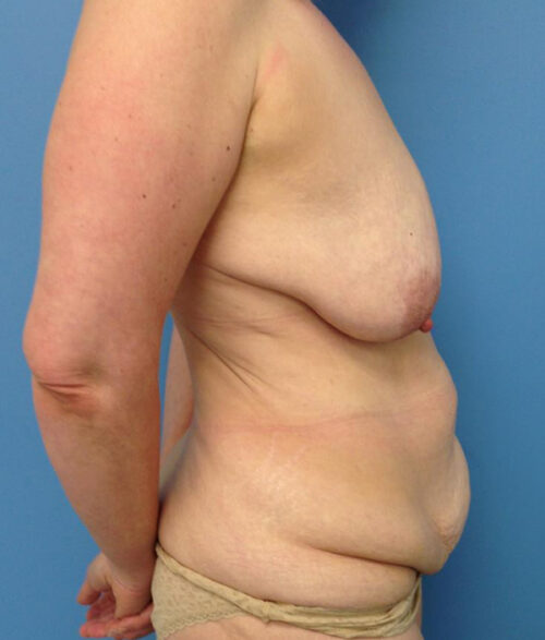 Breast Lift
