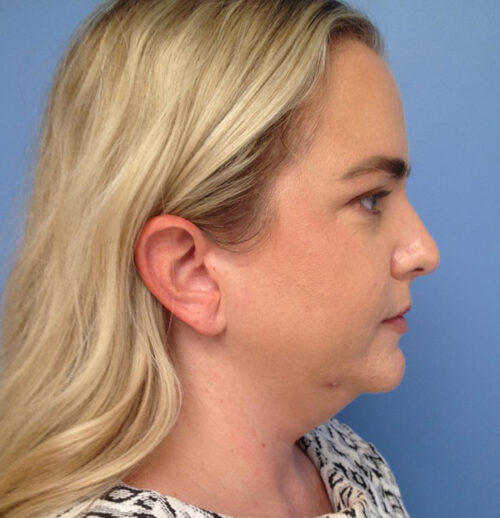 Face & Neck Lift