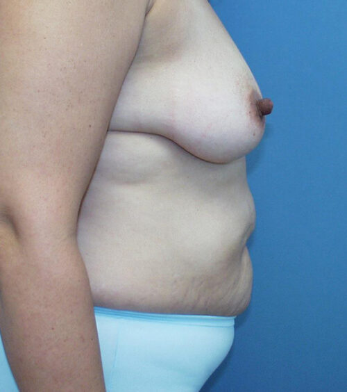 Tummy Tuck (Abdominoplasty) Before and After Photos
