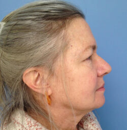 Eyelid Surgery