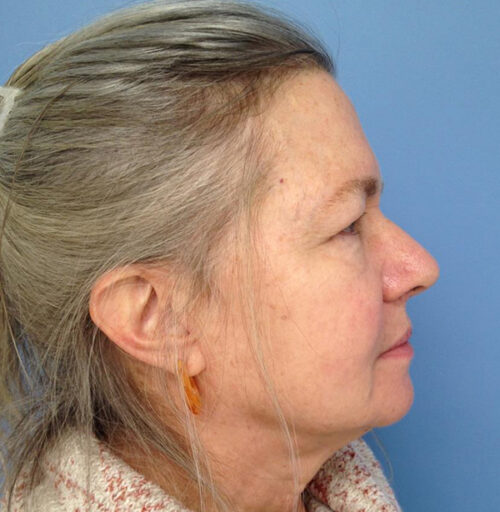Eyelid Surgery