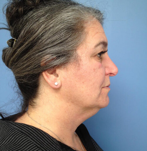 Eyelid Surgery