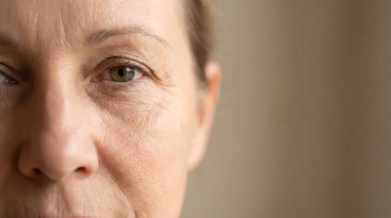 upper blepharoplasty aging eye hooding close up woman's eye with hooded lid and wrinkles illustrating upper blepharoplasty candidacy